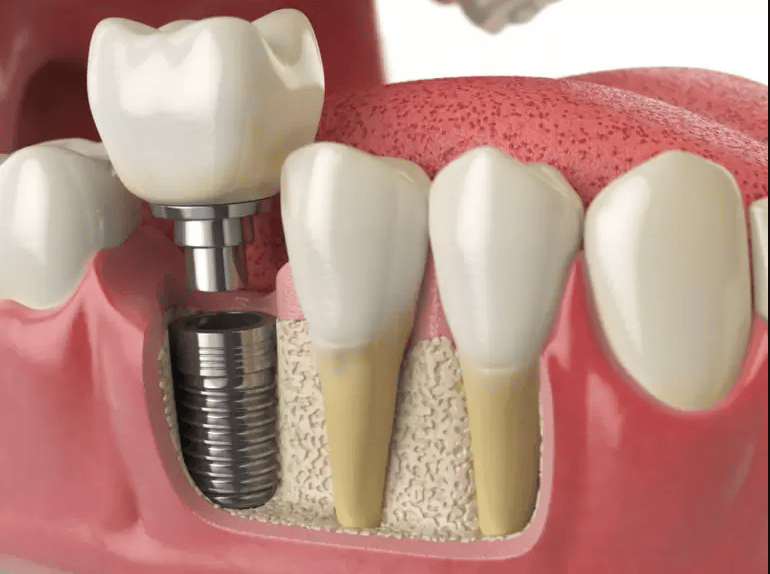 Dental Implants University Park In Dallas, Texas dental implant 3D illustration preston commons dental care dentist in dallas texas