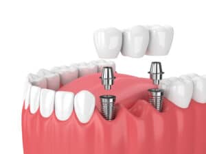 dental implant restoration illustration