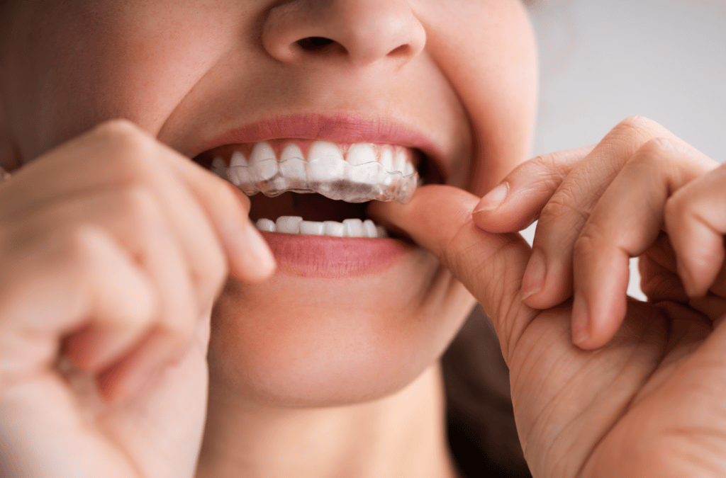 Invisalign Dentist Dallas, What You Need to Know About Invisalign Sports Guards and Night Guards DR. Justin Moseley. Moseley Dental Group. General, Cosmetic, Restorative, Preventative Dentistry Dentist in Dallas TX 752253
