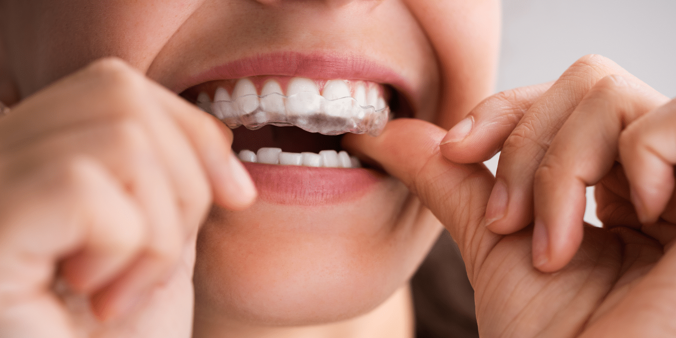 Invisalign Dentist Dallas PCDC Cosmetic Dentist Dallas 75225