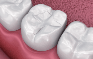 dental fillings 3D illustration