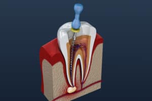 root canal illustration