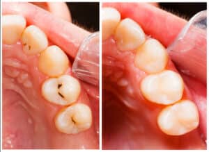 Fillings in Dallas