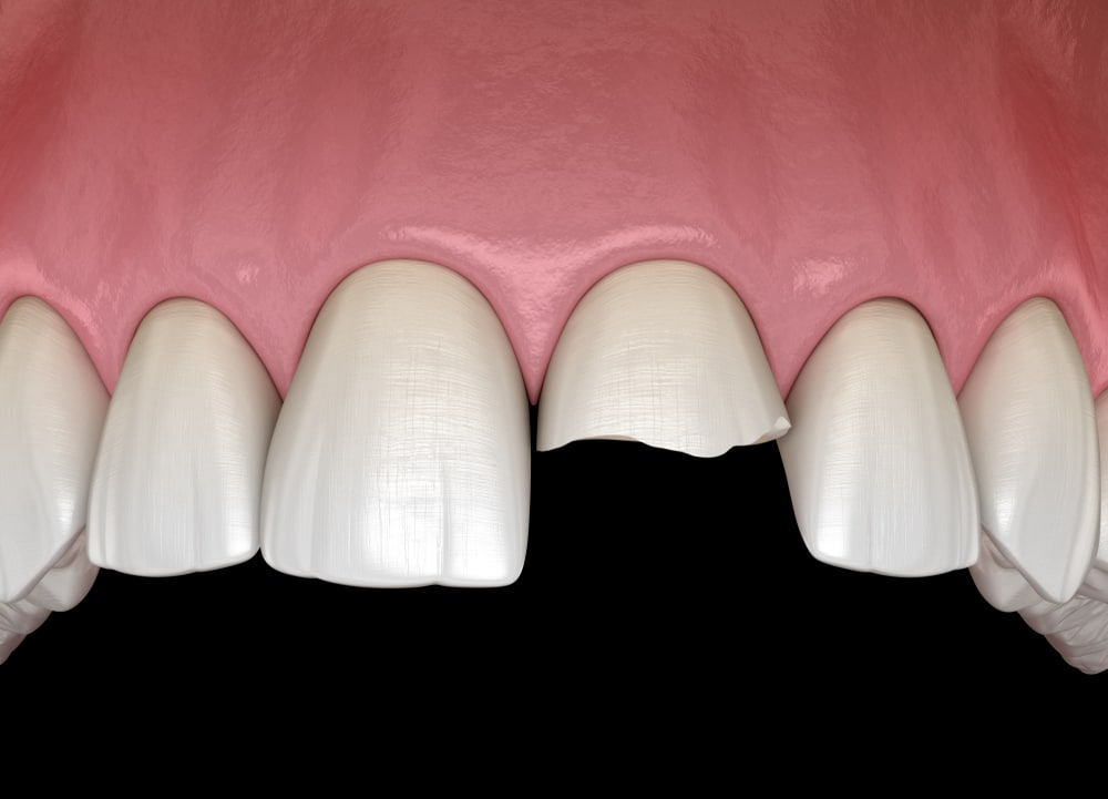 How Moseley Dental Group Can Help Emergency Dentistry Dallas TX Broken Teeth DR. Justin Moseley. Moseley Dental Group. General, Cosmetic, Restorative, Preventative Dentistry Dentist in Dallas TX 752253