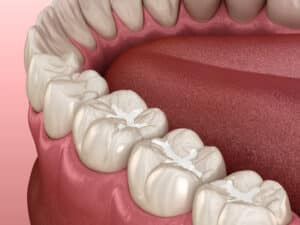 sealants preston commons dental care dentist in dallas, tx
